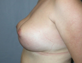 Patient # 48277 After Photo # 6